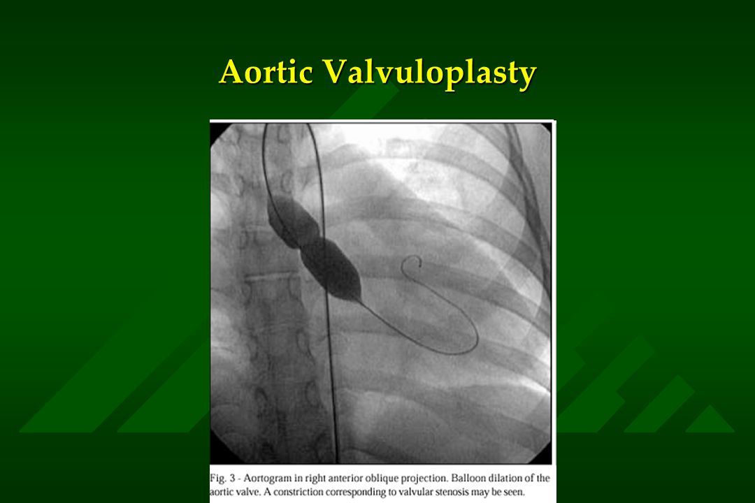 Aortic Valvuloplasty