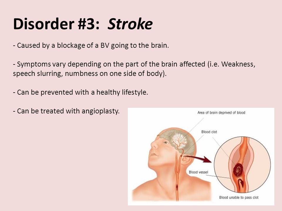 Disorder #3: Stroke - Caused by a blockage of a BV going to the brain.