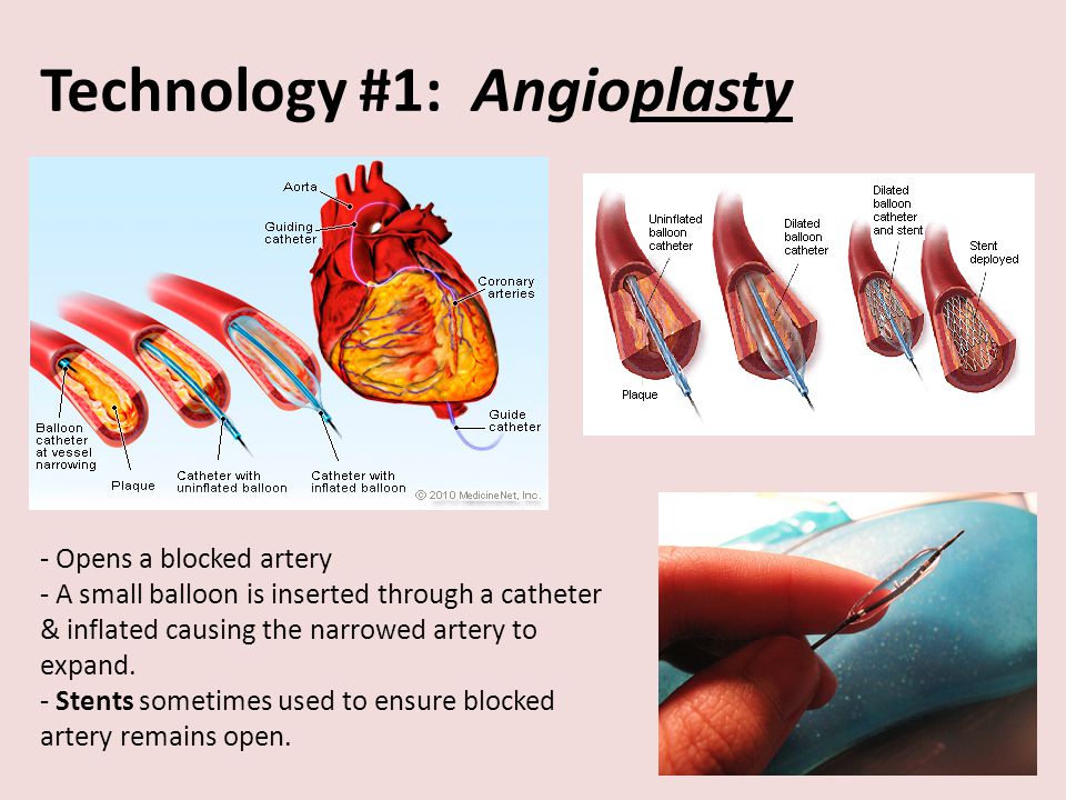 Technology #1: Angioplasty - Opens a blocked artery - A small balloon is inserted through a catheter & inflated causing the narrowed artery to expand.
