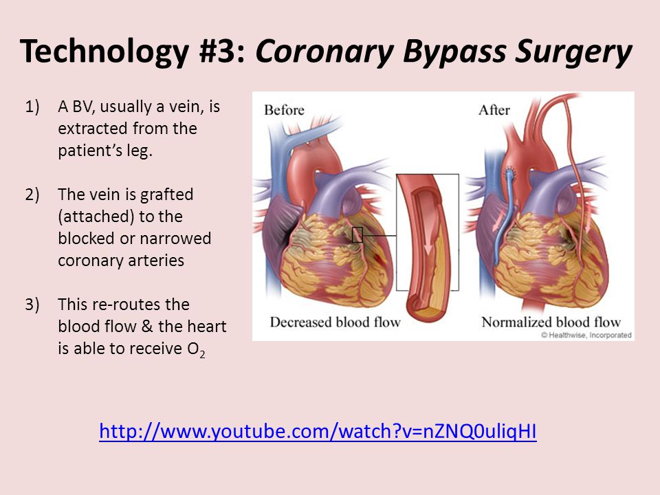 Technology #3: Coronary Bypass Surgery 1)A BV, usually a vein, is extracted from the patient’s leg.