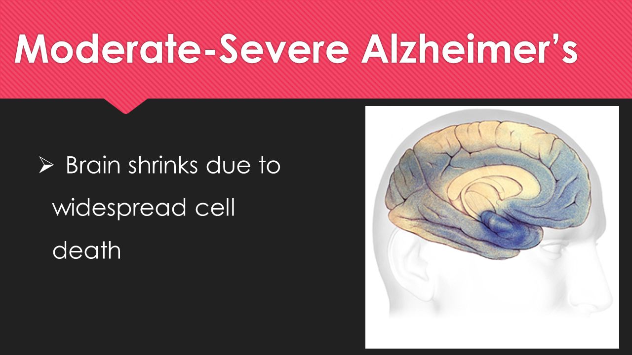 Moderate-Severe Alzheimer’s  Brain shrinks due to widespread cell death