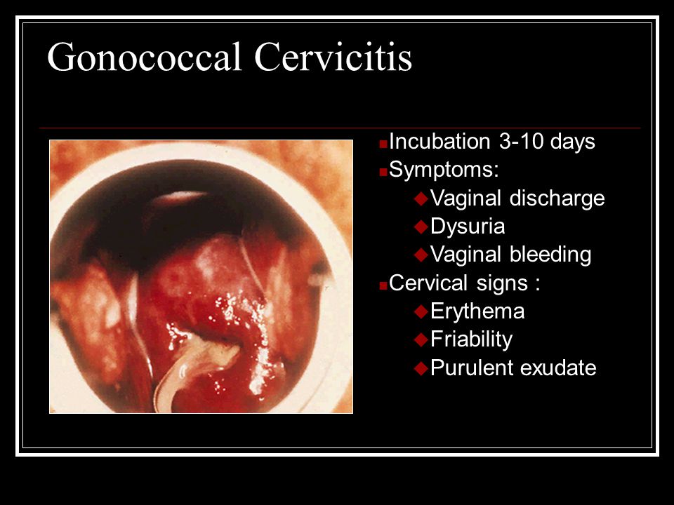 Gonococcal Cervicitis Incubation 3-10 days Symptoms: u Vaginal discharge u Dysuria u Vaginal bleeding Cervical signs : u Erythema u Friability u Purulent exudate