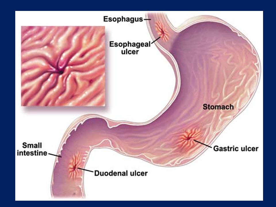 prostatitis prednison