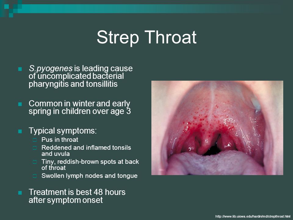 Strep Throat S.pyogenes is leading cause of uncomplicated bacterial pharyng...