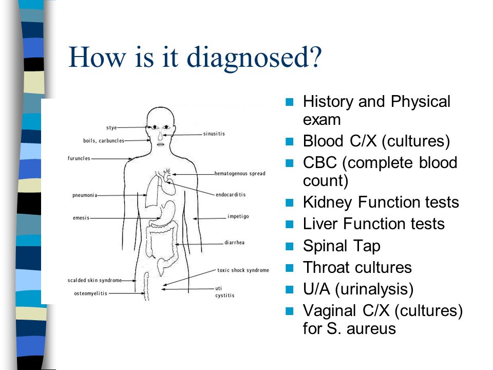 Toxic Shock Syndrome: Symptoms & Causes - Video & Lesson Transcript