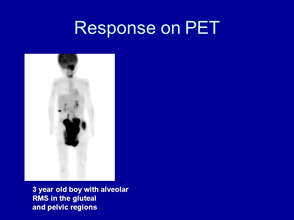 Response on PET 3 year old boy with alveolar RMS in the gluteal and pelvic regions