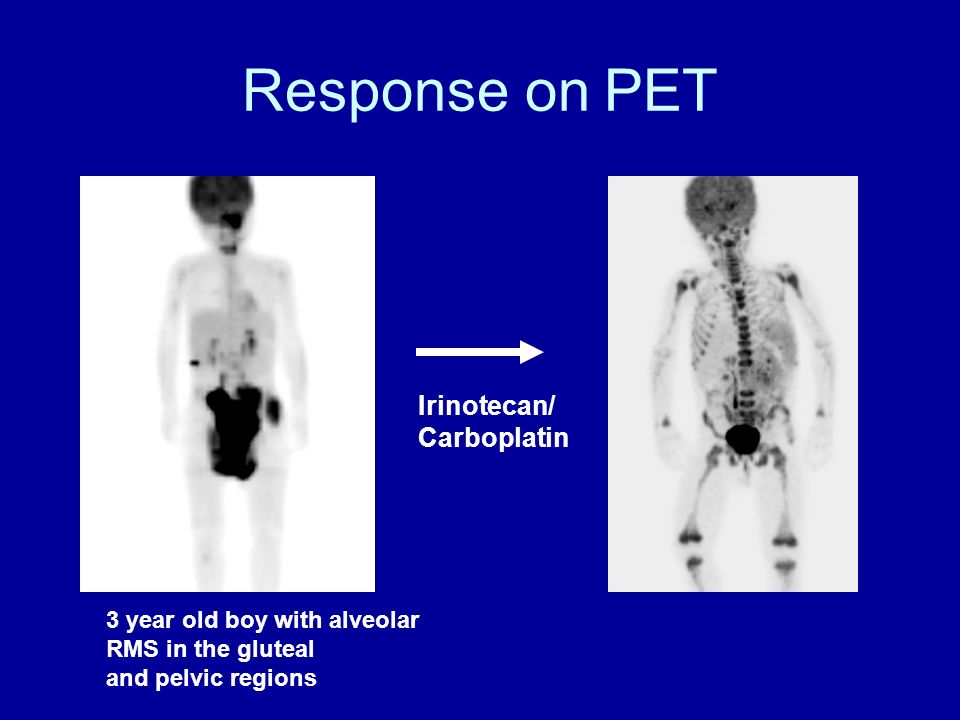 Response on PET Irinotecan/ Carboplatin 3 year old boy with alveolar RMS in the gluteal and pelvic regions