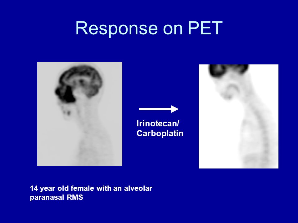 Response on PET 14 year old female with an alveolar paranasal RMS Irinotecan/ Carboplatin
