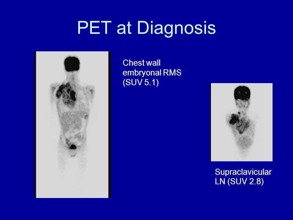 Chest wall embryonal RMS (SUV 5.1) Supraclavicular LN (SUV 2.8) PET at Diagnosis