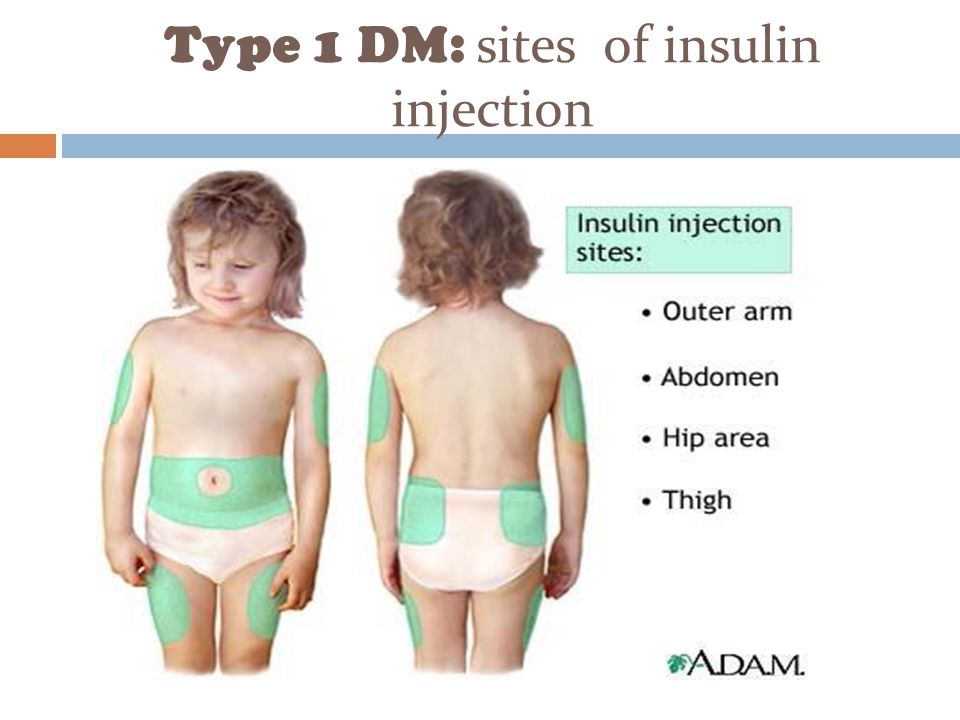 Type 1 DM: sites of insulin injection