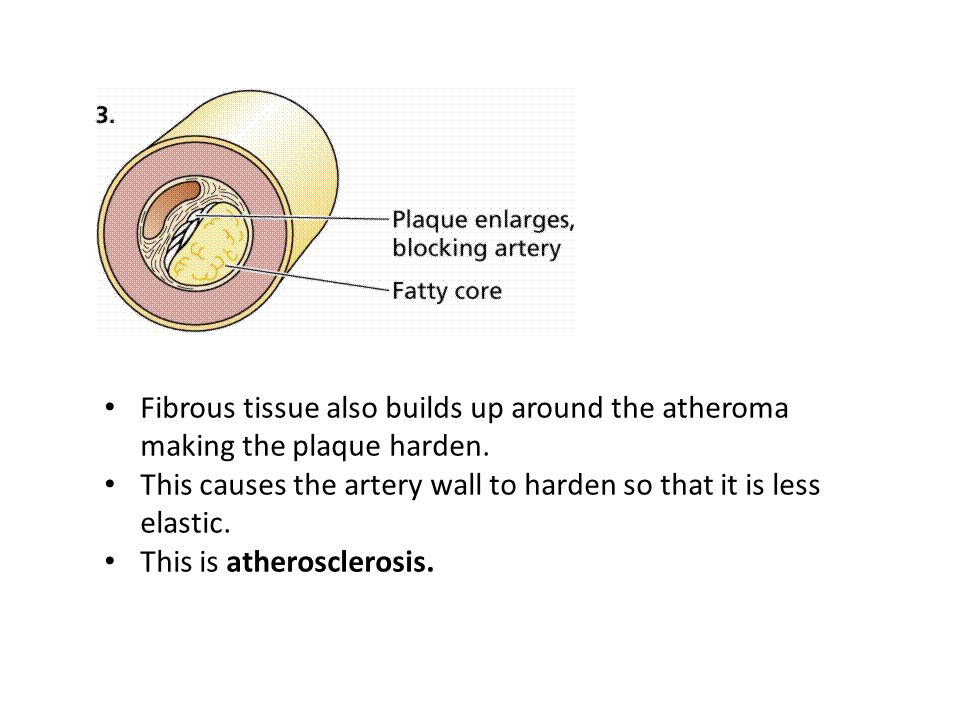 Fibrous tissue also builds up around the atheroma making the plaque harden.