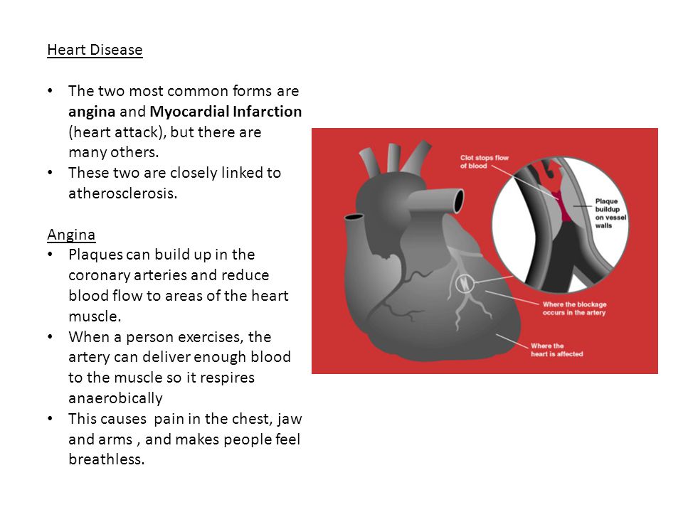 Heart Disease The two most common forms are angina and Myocardial Infarction (heart attack), but there are many others.