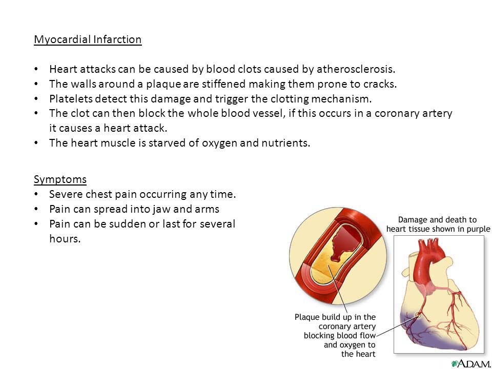 Myocardial Infarction Heart attacks can be caused by blood clots caused by atherosclerosis.
