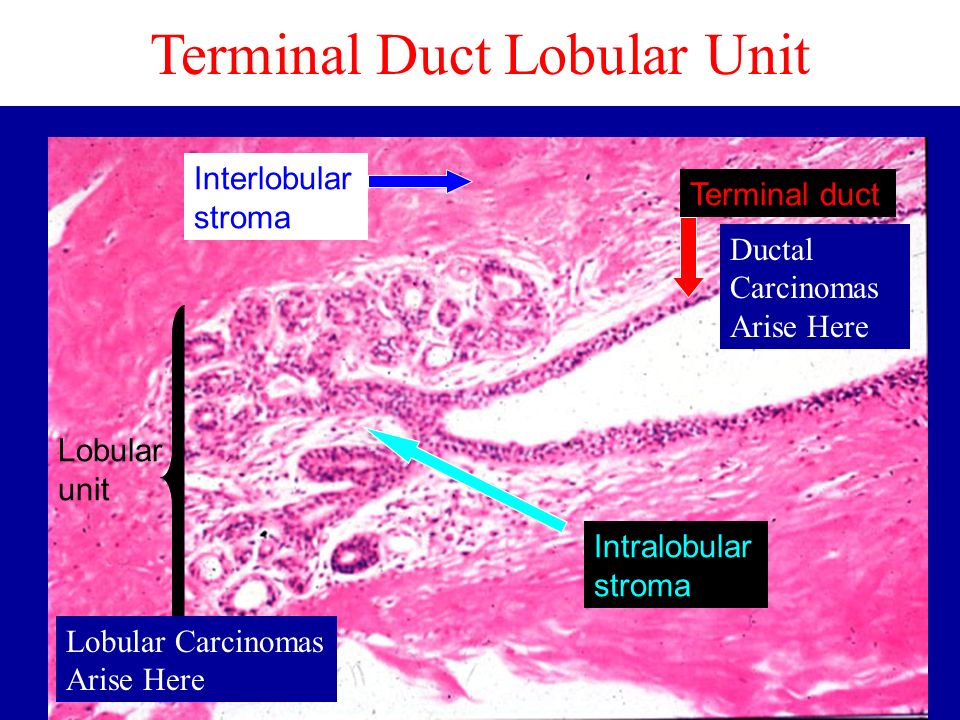 intralobular breast cancer Wrinkled pink pussy