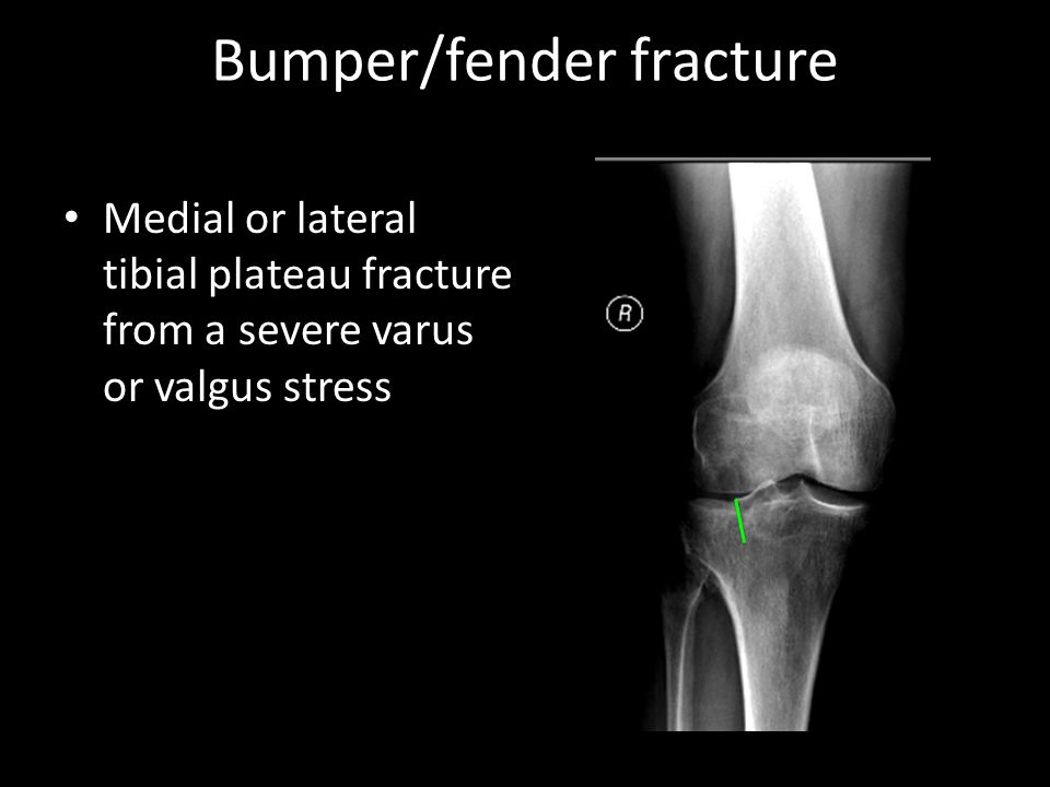 Bumper/fender fracture Medial or lateral tibial plateau fracture from a sev...