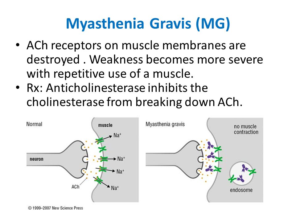 Myasthenia Gravis (MG) ACh receptors on muscle membranes are destroyed.