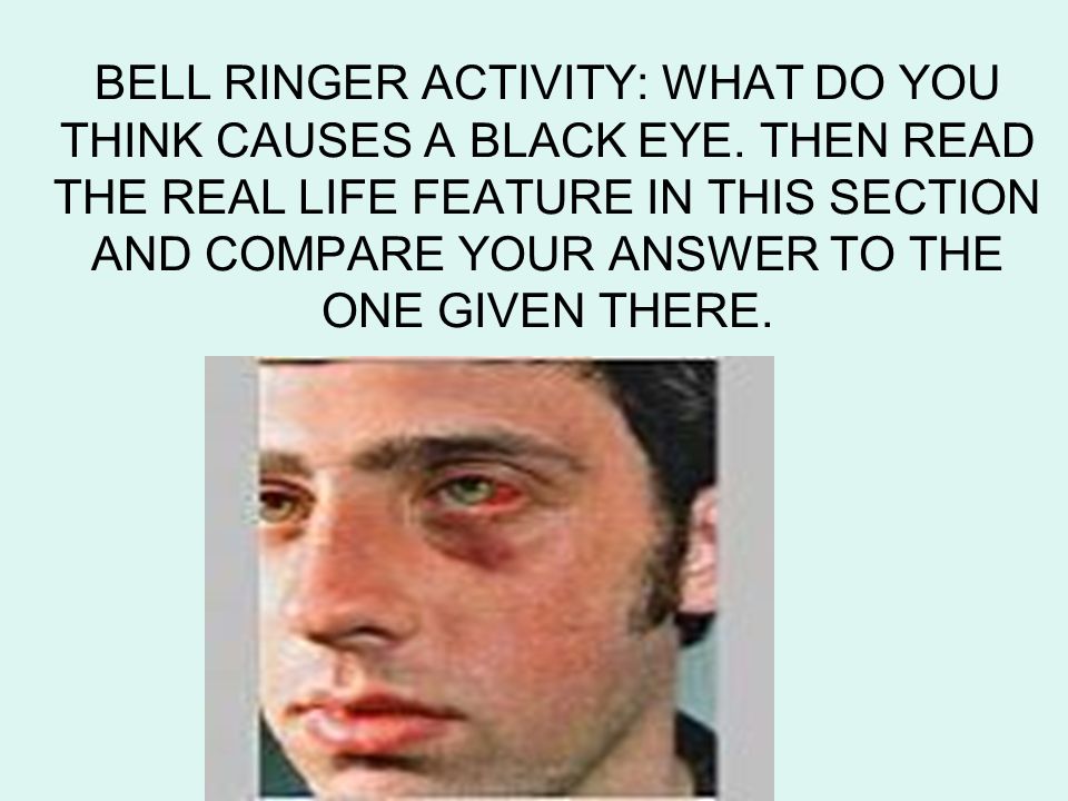BELL RINGER ACTIVITY: WHAT DO YOU THINK CAUSES A BLACK EYE.