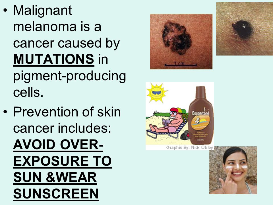 Malignant melanoma is a cancer caused by MUTATIONS in pigment-producing cells.