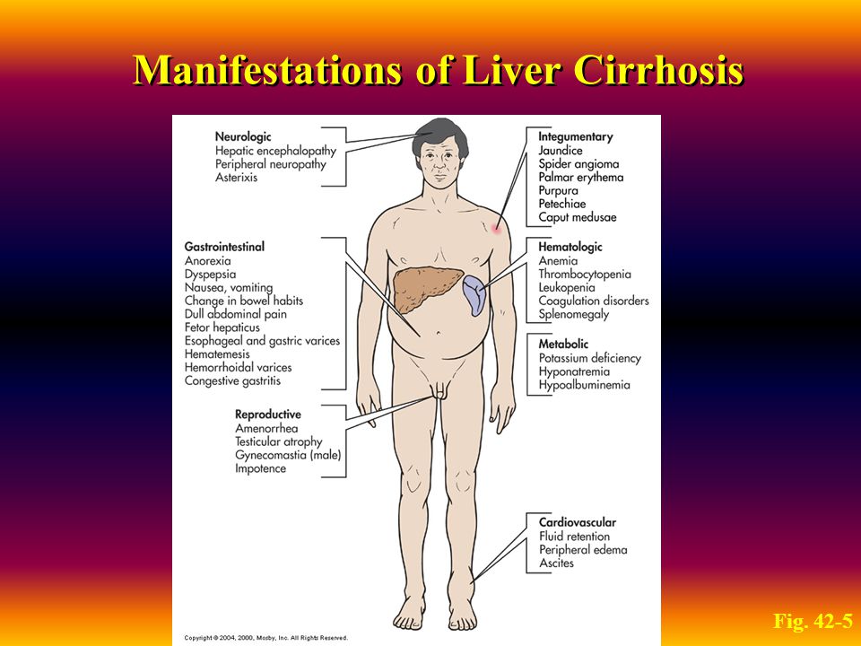 Пальмарная эритема это печени фото Cirrhosis of the Liver (relates to Chapter 42, "Nursing Management: Liver, Bilia