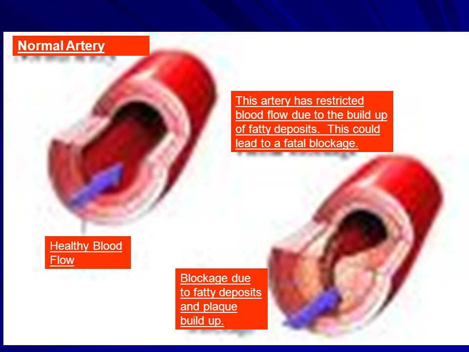 Normal Artery Healthy Blood Flow This artery has restricted blood flow due to the build up of fatty deposits.