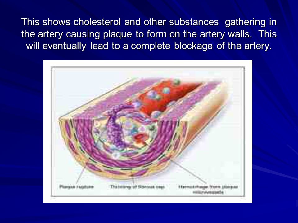 This shows cholesterol and other substances gathering in the artery causing plaque to form on the artery walls.