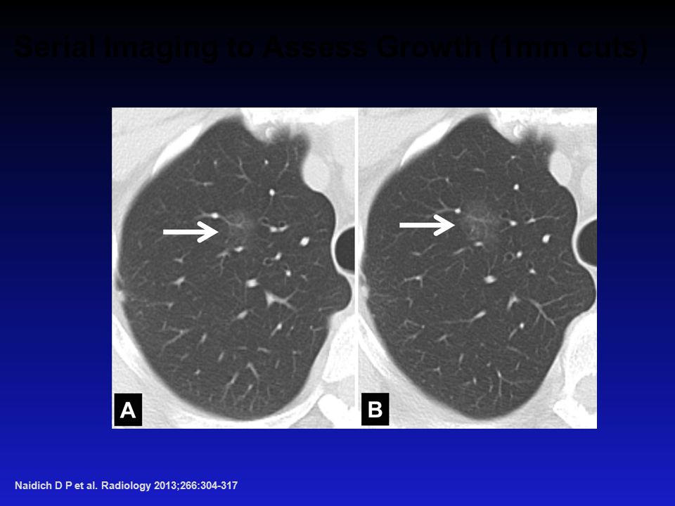 Serial Imaging to Assess Growth (1mm cuts) Naidich D P et al. Radiology 2013;266: