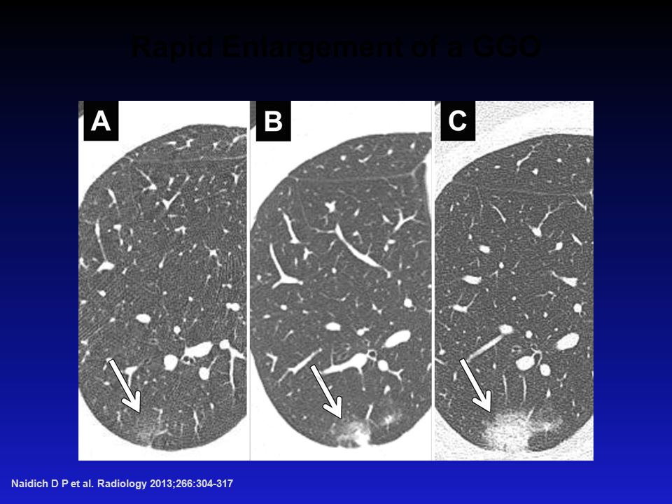 Rapid Enlargement of a GGO Naidich D P et al. Radiology 2013;266: