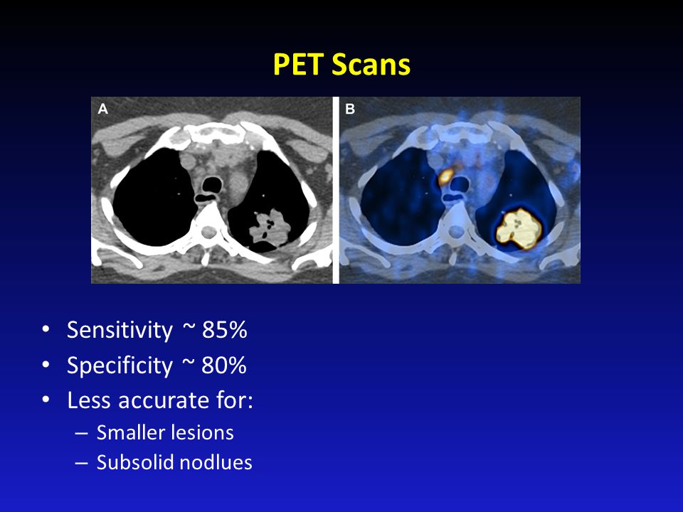 PET Scans Sensitivity ~ 85% Specificity ~ 80% Less accurate for: – Smaller lesions – Subsolid nodlues