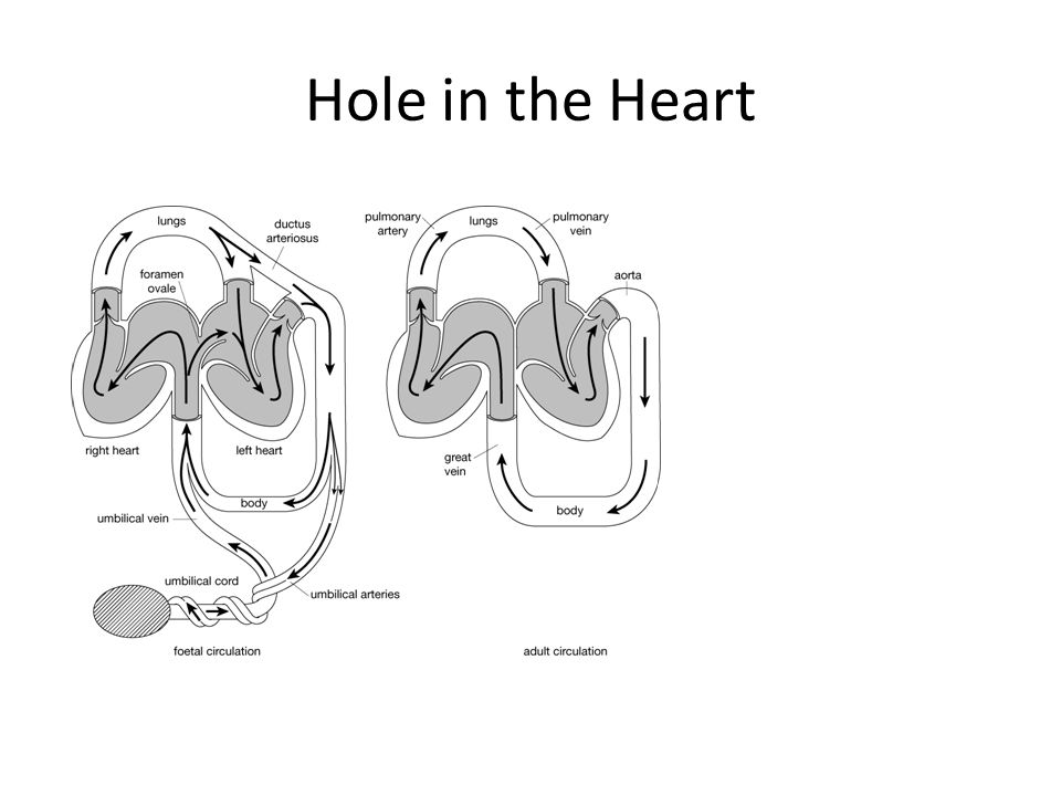 Hole in the Heart