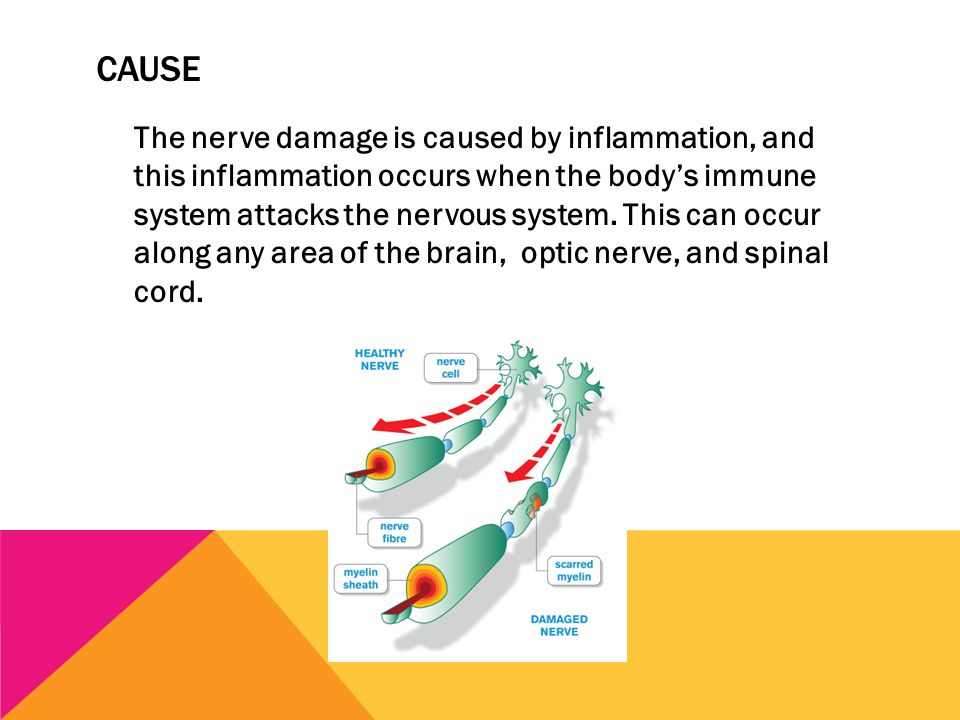 CAUSE The nerve damage is caused by inflammation, and this inflammation occurs when the body’s immune system attacks the nervous system.
