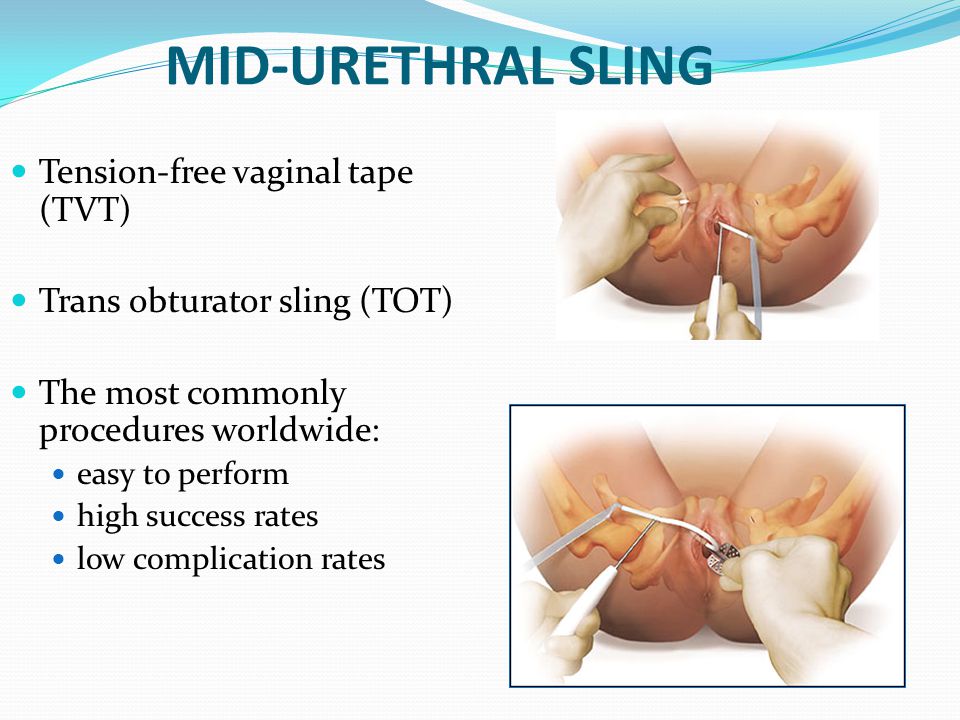 Pdf transobturator tape erosion associated with leg pain