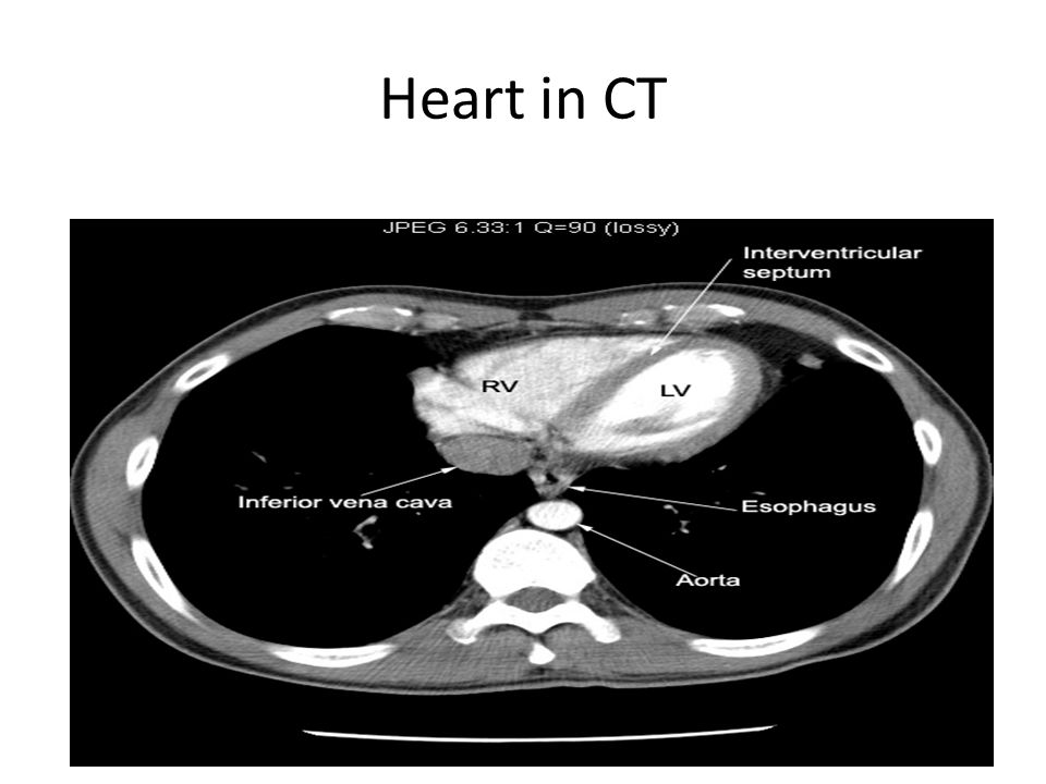 Computed Tomography of the Cardiovascular System