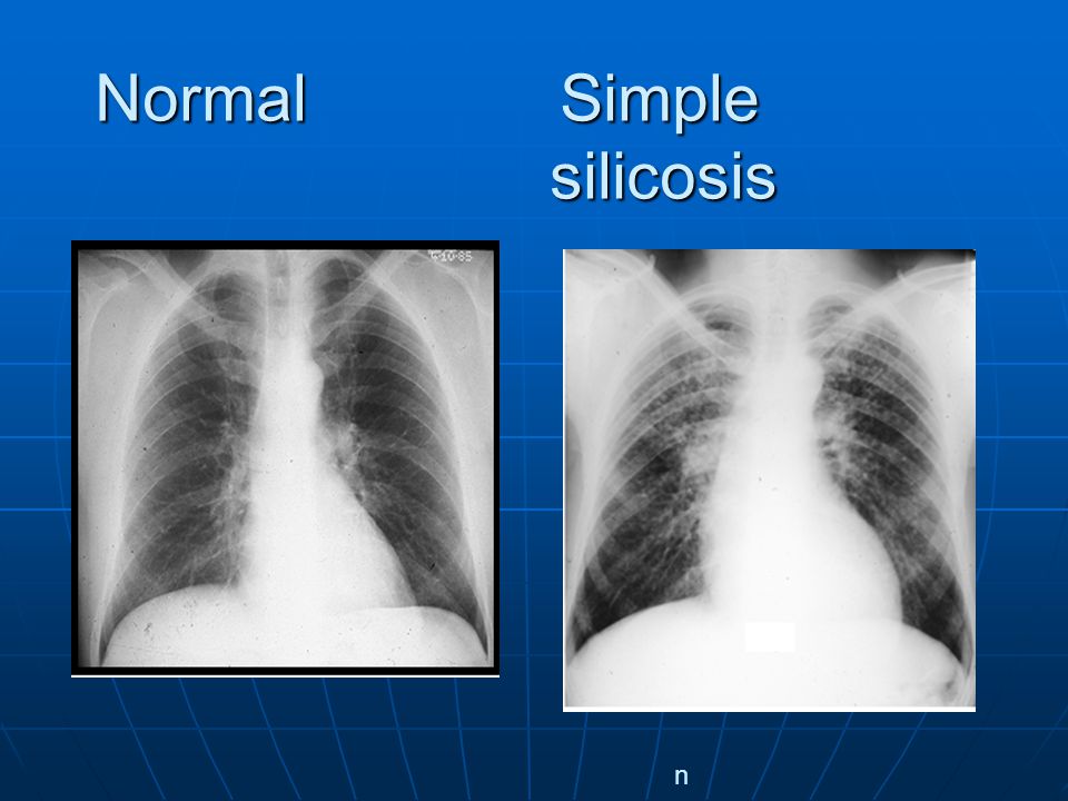 Normal Simple silicosis Normal Simple silicosis noal chest x-raynoal chest x-ray