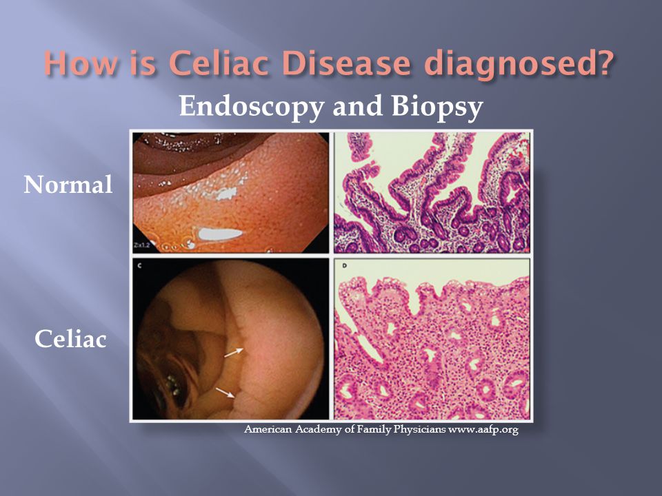 Endoscopy and Biopsy Normal Celiac American Academy of Family Physicians
