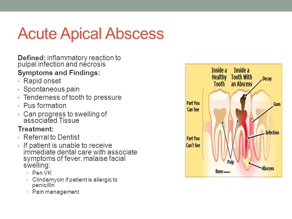 Penicillin or clindamycin for tooth infection
