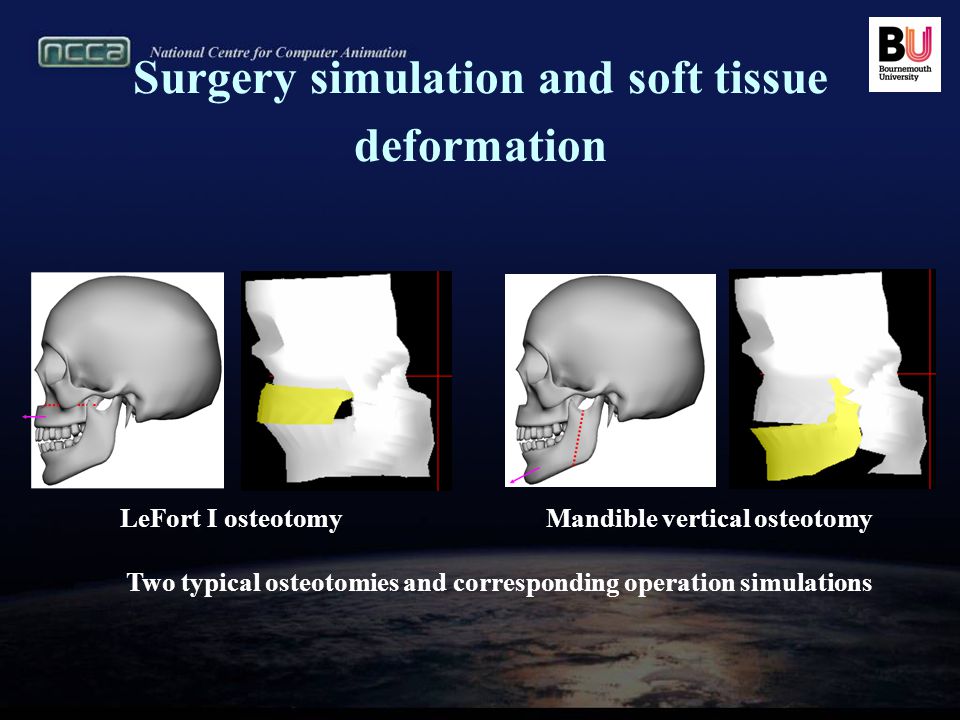 X-ray Based Craniofacial Visualization and Surgery Simulation Junjun Pan 1,  Jian J Zhang 1, Yanning Zhang 2, Hong Zhou 3 - ppt download