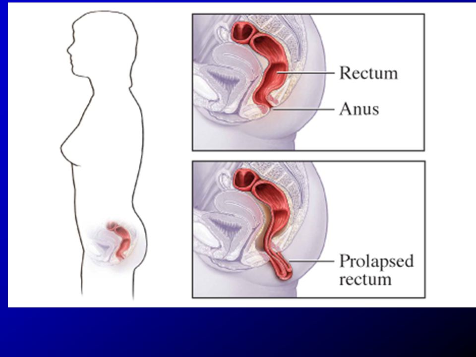 Weightlifter Rectal Prolapse