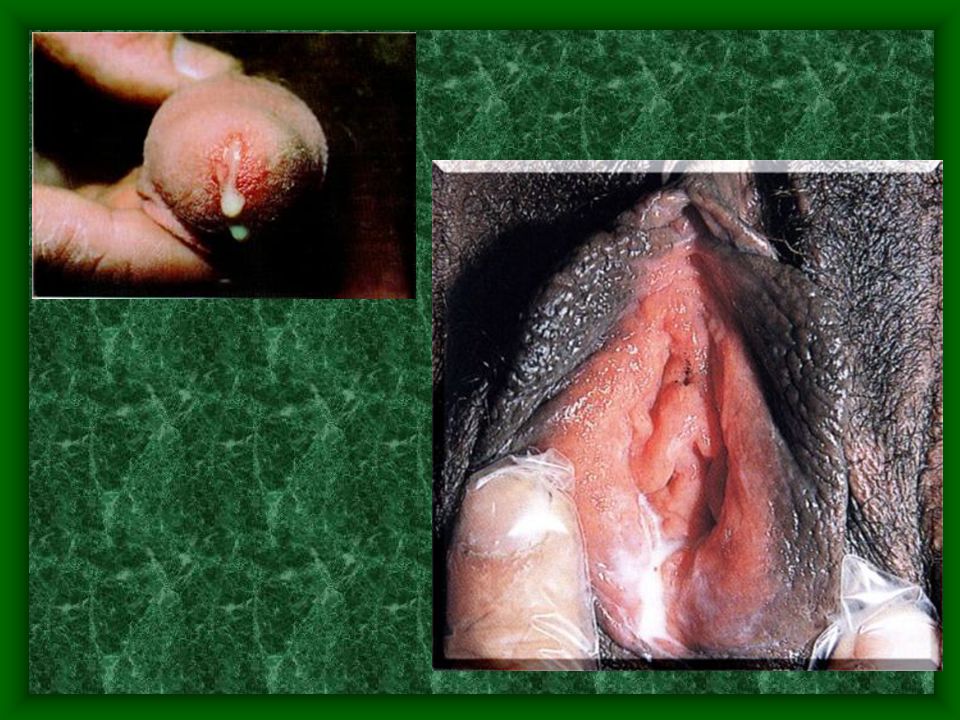 get-genital-herpes-from-oral-sex-vintage-hippy-porn-lady