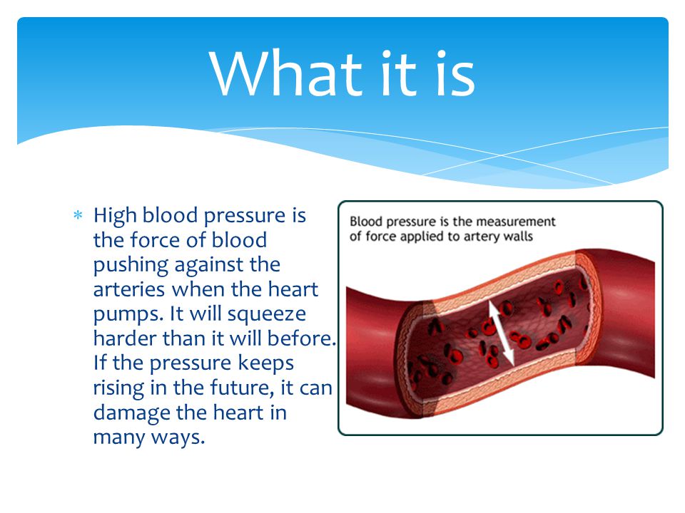  High blood pressure is the force of blood pushing against the arteries when the heart pumps.