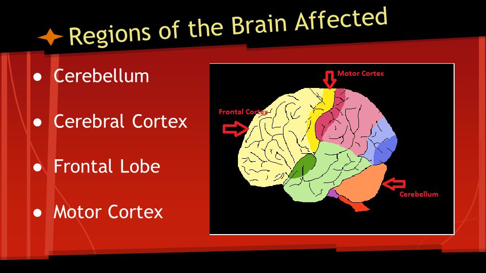 Regions of the Brain Affected ● Cerebellum ● Cerebral Cortex ● Frontal Lobe ● Motor Cortex