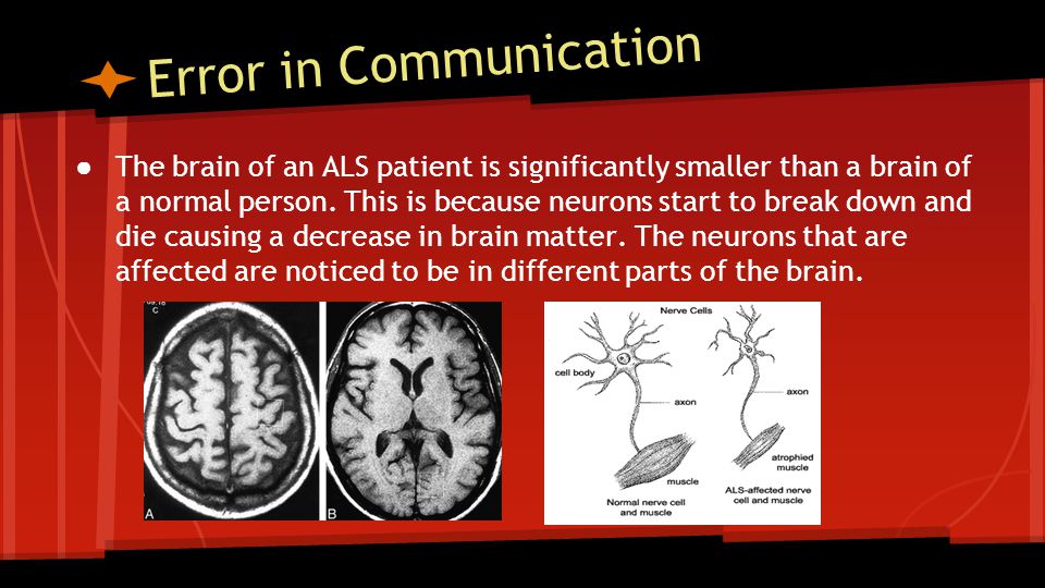 Error in Communication ● The brain of an ALS patient is significantly smaller than a brain of a normal person.