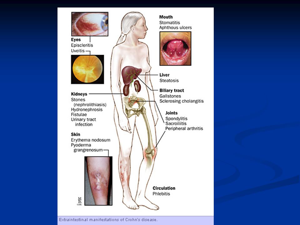 ulcer vezical sangerari dupa biopsie prostata
