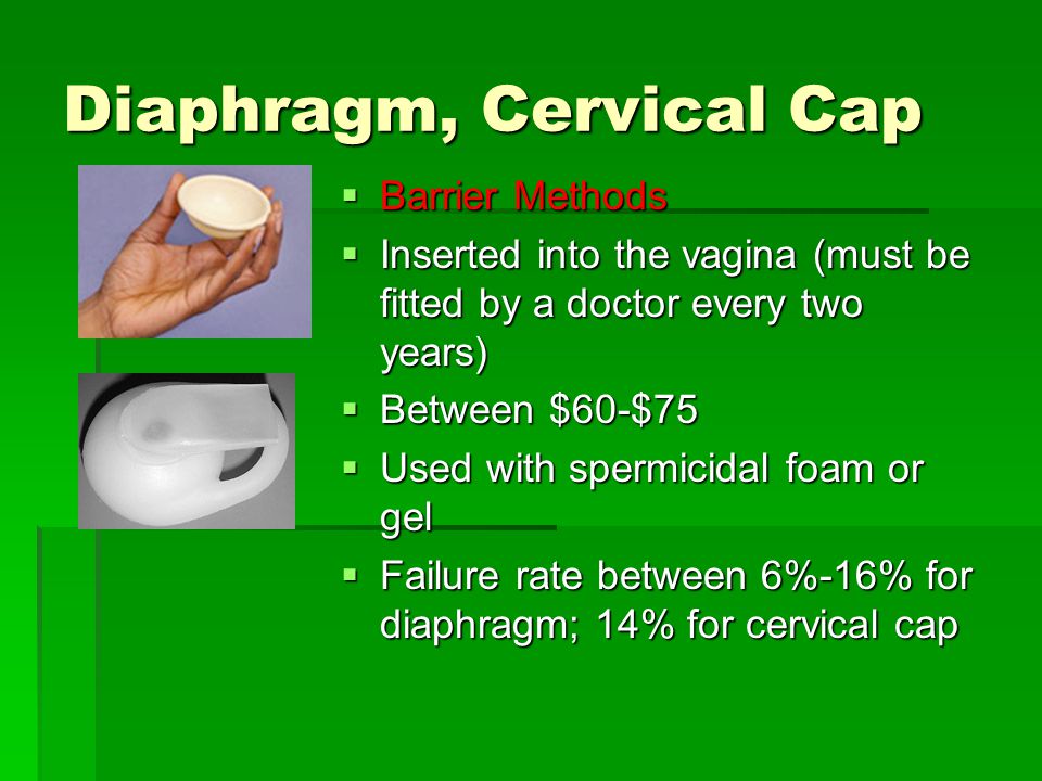Diaphragm, Cervical Cap  Barrier Methods  Inserted into the vagina (must be fitted by a doctor every two years)  Between $60-$75  Used with spermicidal foam or gel  Failure rate between 6%-16% for diaphragm; 14% for cervical cap