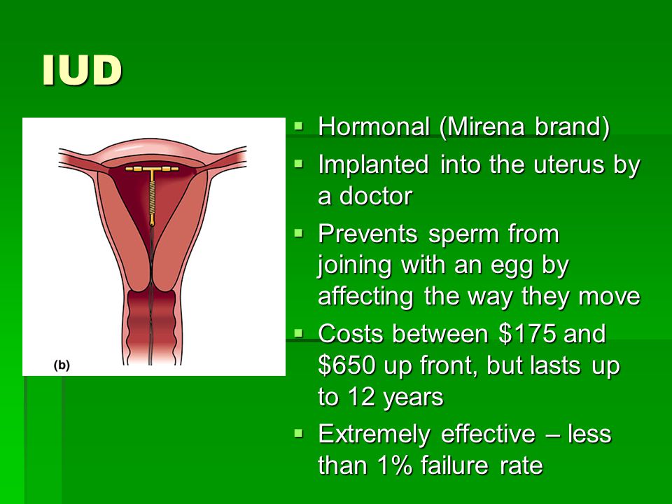 IUD  Hormonal (Mirena brand)  Implanted into the uterus by a doctor  Prevents sperm from joining with an egg by affecting the way they move  Costs between $175 and $650 up front, but lasts up to 12 years  Extremely effective – less than 1% failure rate