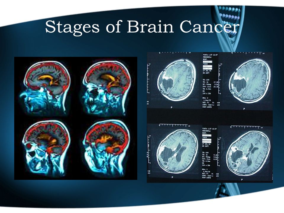 Stages of Brain Cancer