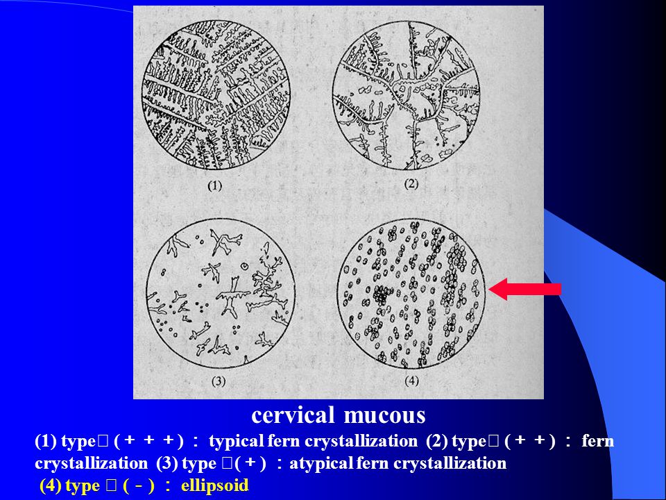 cervical mucous (1) type Ⅰ ( ＋＋＋ ) ： typical fern crystallization (2) type Ⅱ ( ＋＋ ) ： fern crystallization (3) type Ⅲ ( ＋ ) ： atypical fern crystallization (4) type Ⅳ ( － ) ： ellipsoid