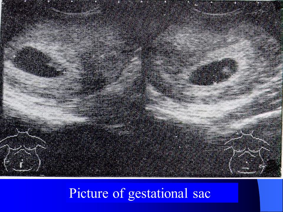 Picture of gestational sac