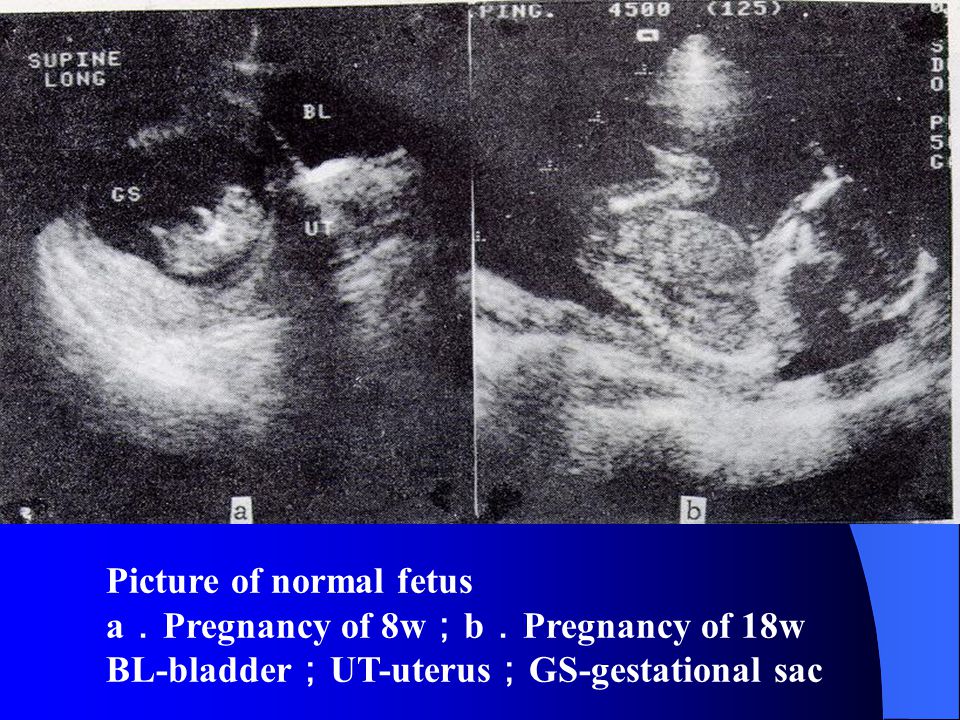 Picture of normal fetus a ． Pregnancy of 8w ； b ． Pregnancy of 18w BL-bladder ； UT-uterus ； GS-gestational sac