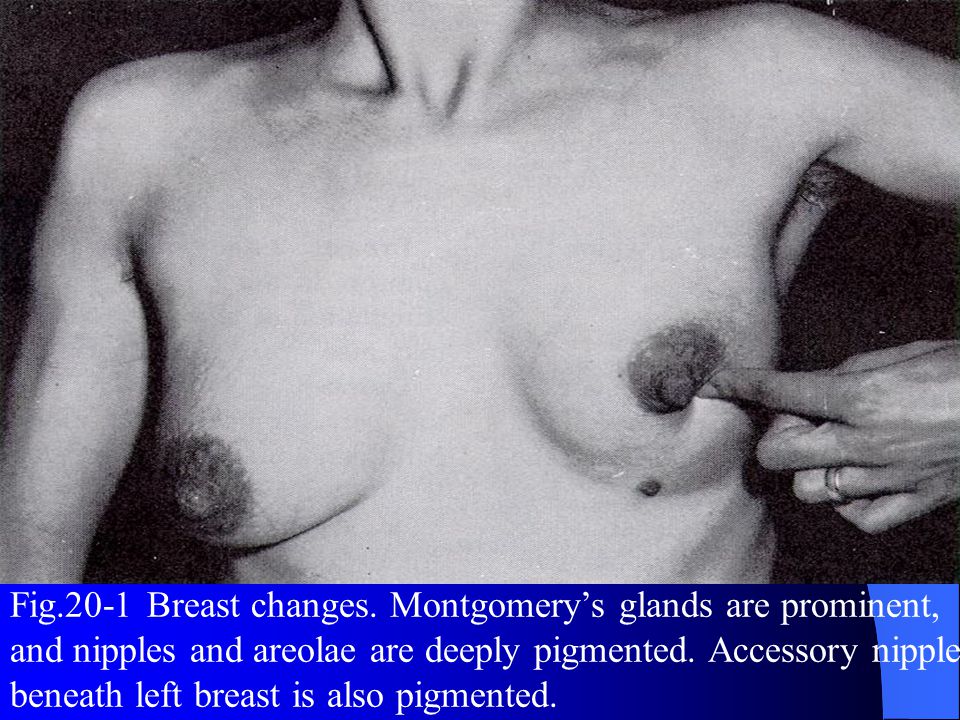 Fig.20-1 Breast changes.
