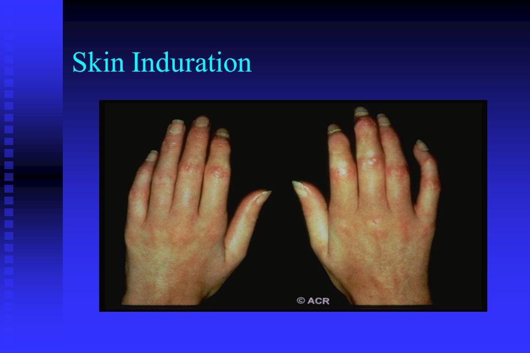 Skin Induration